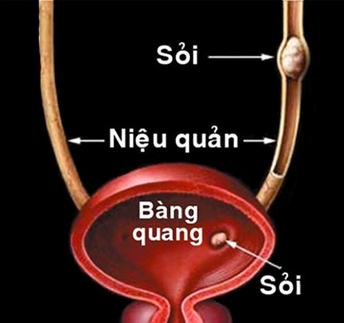 Sỏi niệu quản